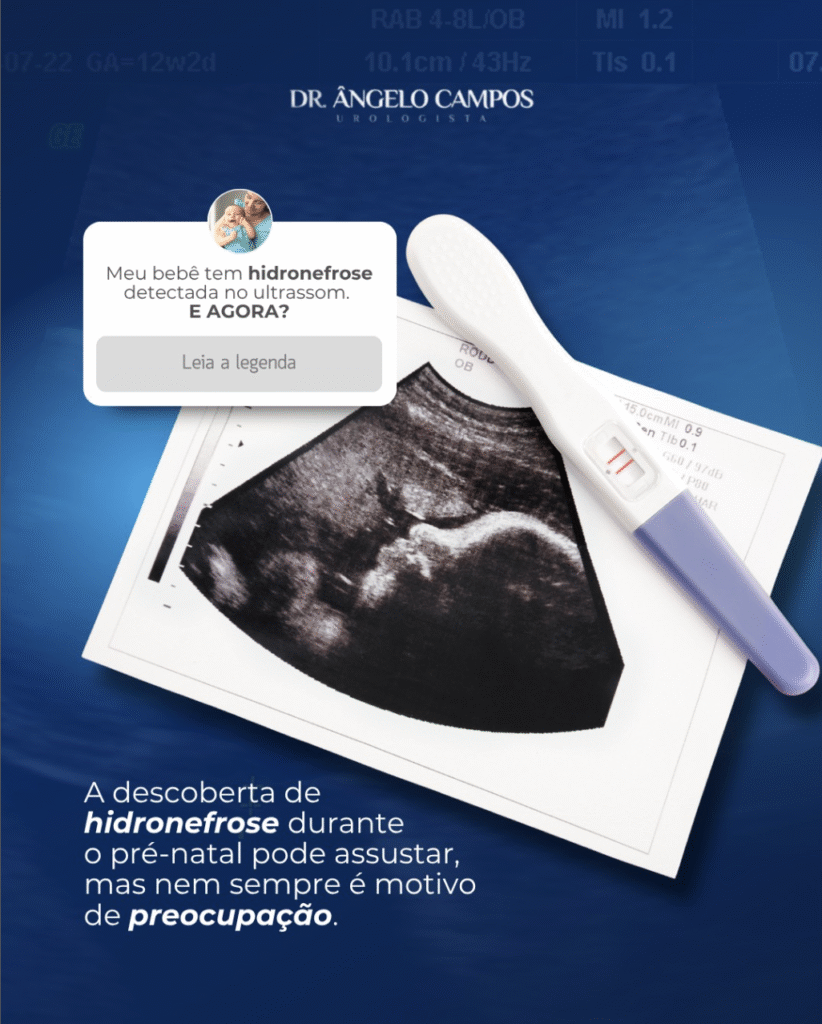 Meu bebê tem hidronefrose detectada no ultrassom, o que fazer?